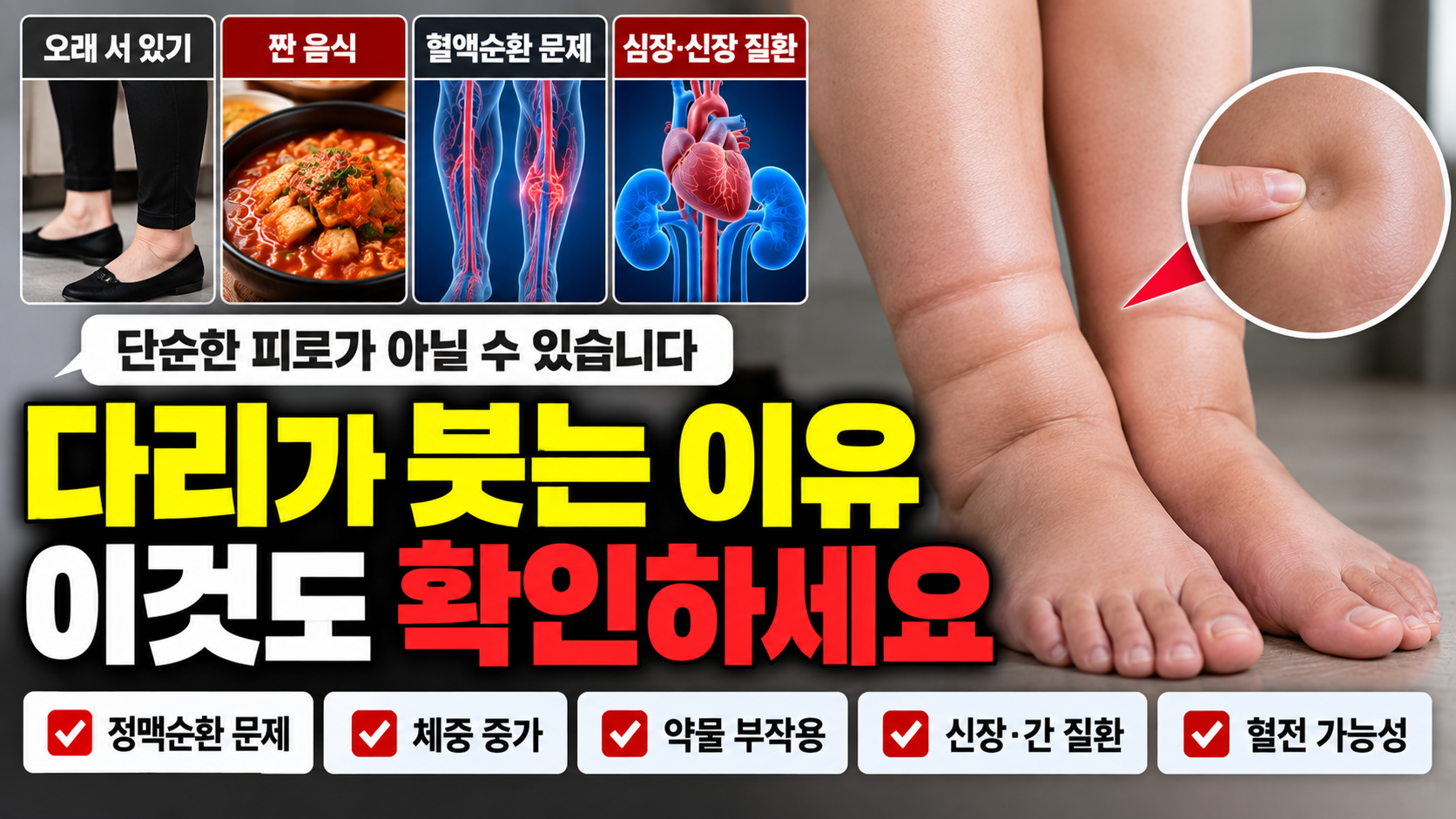 다리가 붓는 이유 썸네일