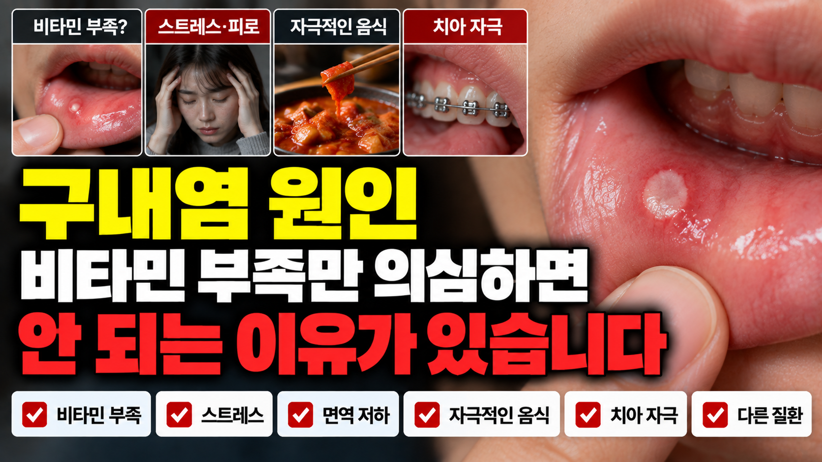 구내염 원인 썸네일